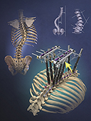 Spine Augmentation for  Treatment of Scoliosis